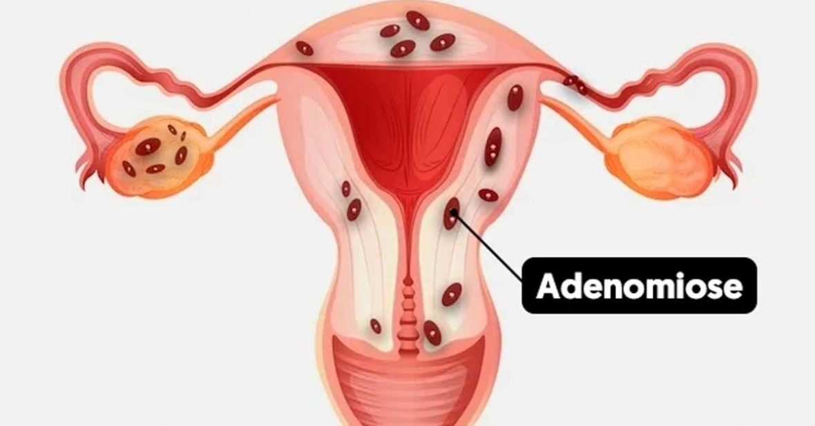 adenomiose