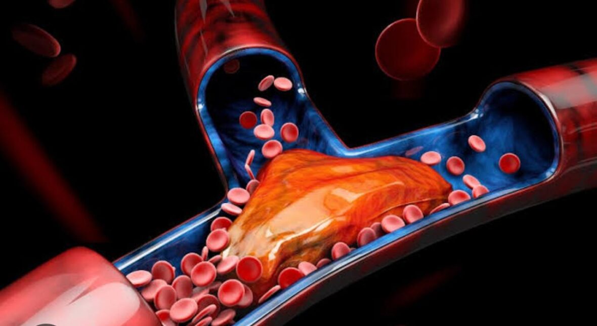 Coágulos sanguíneos